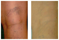Mikroskleroterapia pajączków nóg przed i po zabiegu