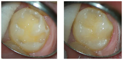 Odbudowa zęba kompozytem przed i po zabiegu