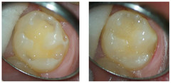 Odbudowa zęba kompozytem przed i po zabiegu