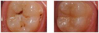 Odbudowa zęba kompozytem przed i po zabiegu