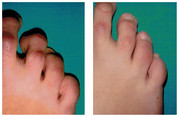 Operacja palca młoteczkowatego / młotkowatego stopy przed i po zabiegu