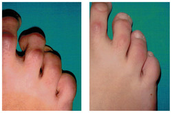 Operacja palca młoteczkowatego stopy przed i po zabiegu
