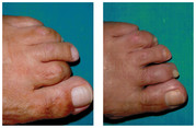 Operacja palca młoteczkowatego stopy przed i po zabiegu