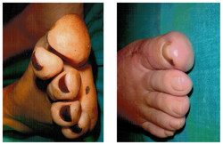 Operacja palucha koślawego / halluksa przed i po zabiegu