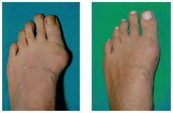 Operacja palucha koślawego / haluksa przed i po zabiegu