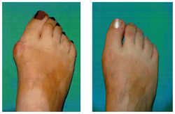 Operacja palucha koślawego / haluksa przed i po zabiegu