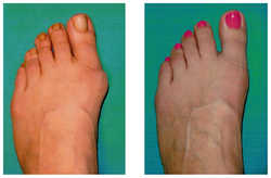 Operacja palucha koślawego / haluksa przed i po zabiegu