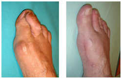 Operacja palucha koślawego / haluksa przed i po zabiegu