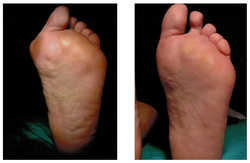 Operacja palucha koślawego / haluksa przed i po zabiegu