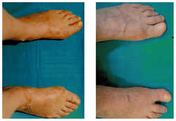 Operacja palucha koślawego / haluksa przed i po zabiegu