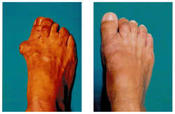 Operacja palucha koślawego / haluksa przed i po zabiegu