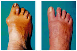 Operacja palucha koślawego / haluksa przed i po zabiegu