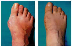 Operacja palucha koślawego / haluksa przed i po zabiegu