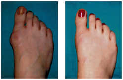 Operacja palucha koślawego / haluksa przed i po zabiegu