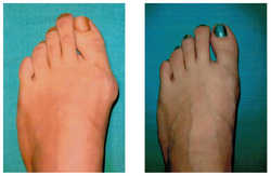 Operacja palucha koślawego / haluksa przed i po zabiegu
