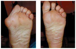 Operacja palucha koślawego / haluksa przed i po zabiegu