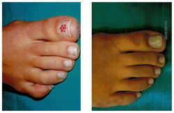 Operacja palucha koślawego / haluksa przed i po zabiegu