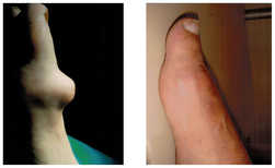 Operacja palucha koślawego / haluksa przed i po zabiegu