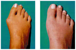 Operacja palucha koślawego / haluksa przed i po zabiegu