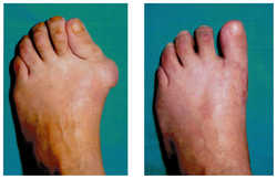 Operacja palucha koślawego / haluksa przed i po zabiegu