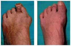 Operacja palucha koślawego / haluksa przed i po zabiegu