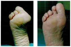 Operacja palucha koślawego / haluksa przed i po zabiegu