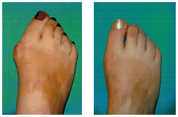 Operacja palucha koślawego / haluksa przed i po zabiegu