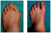 Operacja palucha koślawego / haluksa przed i po zabiegu