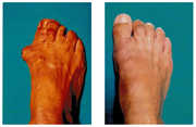Operacja palucha koślawego / haluksa przed i po zabiegu