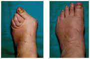 Operacja palucha koślawego / haluksa przed i po zabiegu