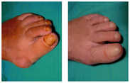 Operacja palucha koślawego / haluksa przed i po zabiegu