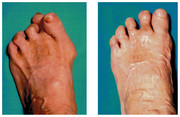 Operacje i leczenie stopy / stawu skokowego przed i po zabiegu