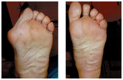 Operacje i leczenie stopy / stawu skokowego przed i po zabiegu