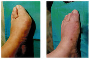 Operacje i leczenie stopy / stawu skokowego przed i po zabiegu