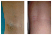 Skleroterapia żylaków przed i po zabiegu