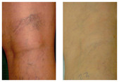 Skleroterapia żylaków przed i po zabiegu