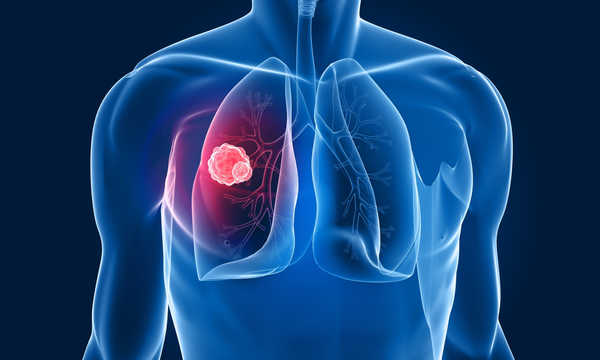 Badanie genetyczne predyspozycji do raka płuc
