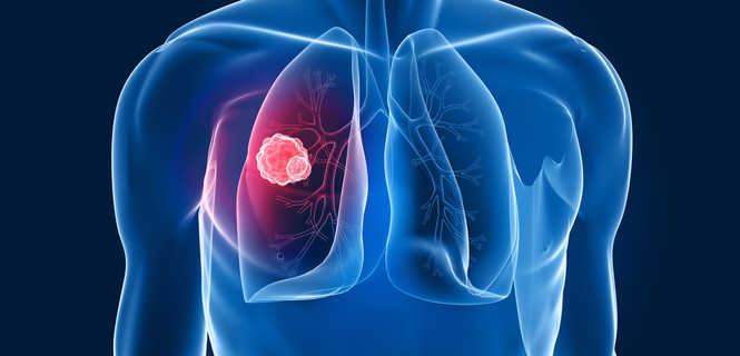 Badanie genetyczne predyspozycji do raka płuc
