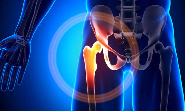 Endoprotezoplastyka stawu biodrowego - wskazania do zabiegu