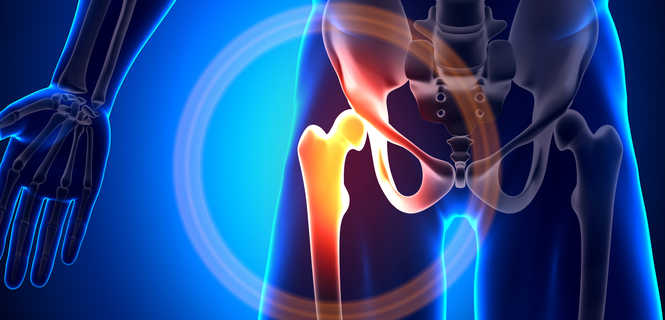 Endoprotezoplastyka stawu biodrowego - wskazania do zabiegu