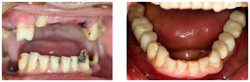 Uzupełnieni braków zębowych za pomocą implantów