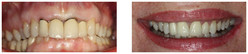 Wymiana niekosmetycznych koron protetycznych oraz uzupełnienie braków zębowych za pomocą implantów