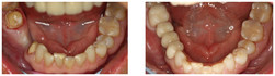 Wymiana niekosmetycznych koron protetycznych oraz uzupełnienie braków zębowych za pomocą implantów