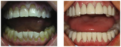 Wykonanie koron pełnoceramicznych na przebarwione zęby