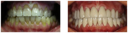 Wykonanie koron pełnoceramicznych na przebarwione zęby