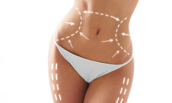 Miejsca na ciele kobiety oznaczone do zabiegu liposukcji laserowej