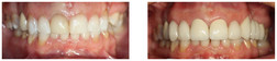Kosmetyczne uzupełnienie braków zębowych za pomocą mostu ceramicznego