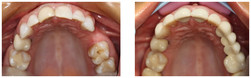 Kosmetyczne uzupełnienie braków zębowych za pomocą mostu ceramicznego