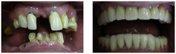 Uzupełnienie braków zębowych za pomocą porcelanowych mostów protetycznych oraz protezy szkieletowej dolnej mocowanej na zatrzaskach