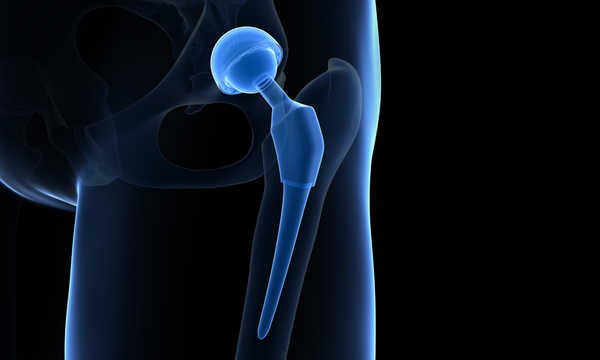 Życie z endoprotezą biodra wiąże się z koniecznością unikania niektórych gwałtownych ruchów oraz nadmiernych obciążeń stawu